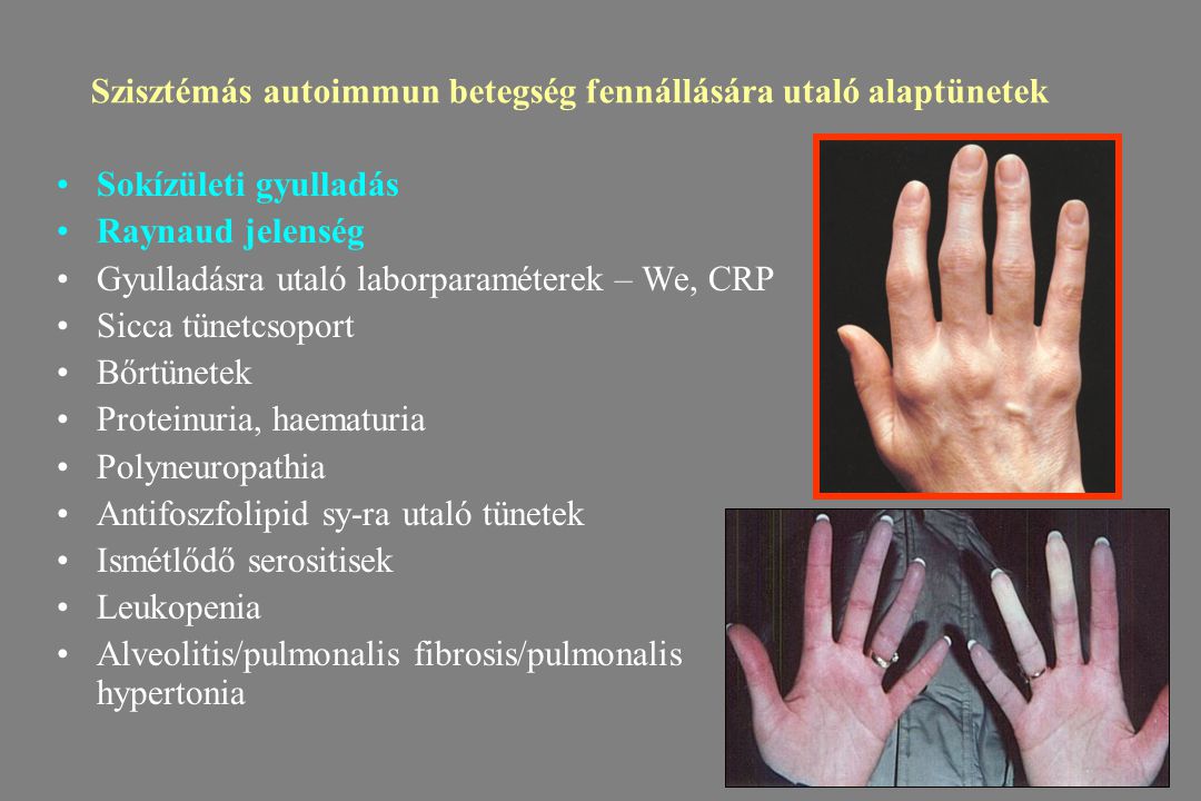 autoimmun betegség sokizületi gyulladás)
